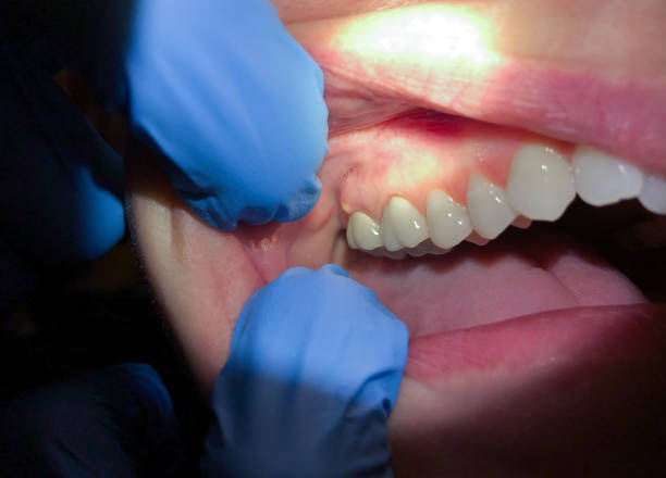 Best Knocked-Out Tooth (Avulsed Tooth) Treatment in Golden Meadow, LA