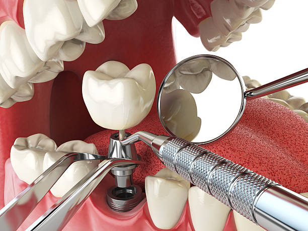 Best Lost Filling or Crown Replacement in Golden Meadow, LA